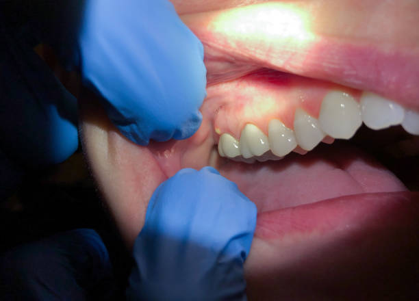 Best Tooth Infection Emergency Dentist  in Belzoni, MS